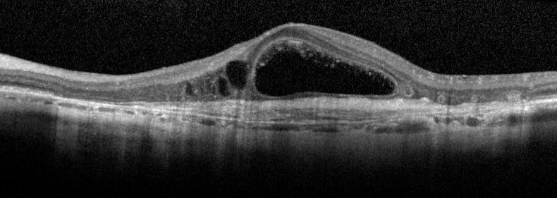 Macula