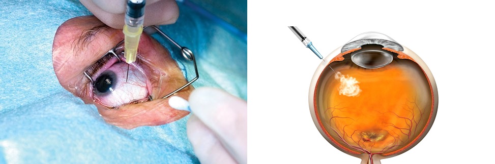 Iniezione Intravitreale