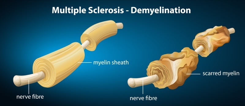 Differenze tra individuo sano e paziente affetto da sclerosi multipla