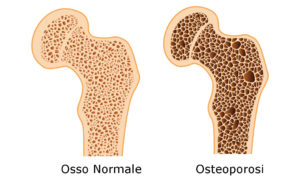 Osteoporosi